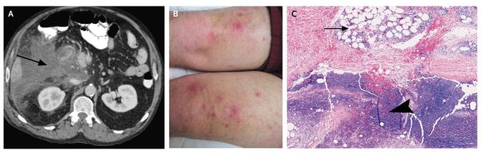 Lobular Panniculitis