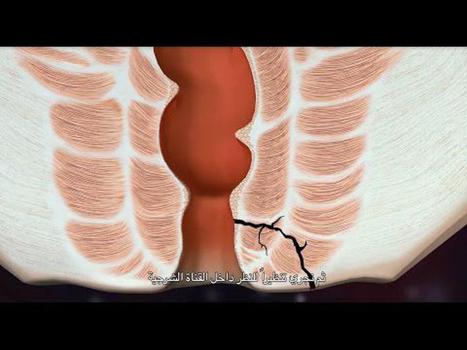 Anal Fistula Repair: Animation