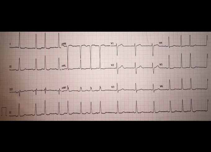 ECG- revision