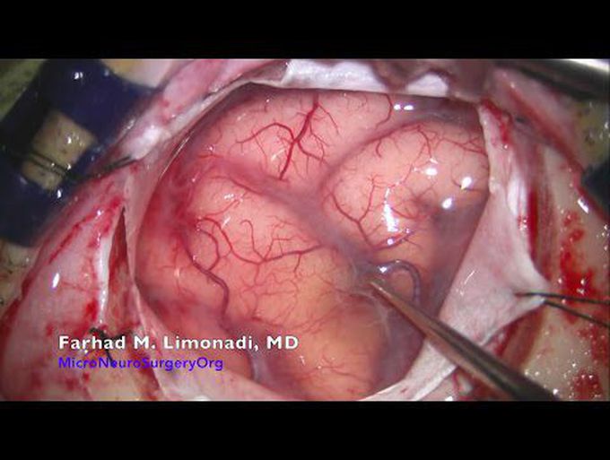 Brain surgery : Surgical resection of vascular malformation Cavernoma