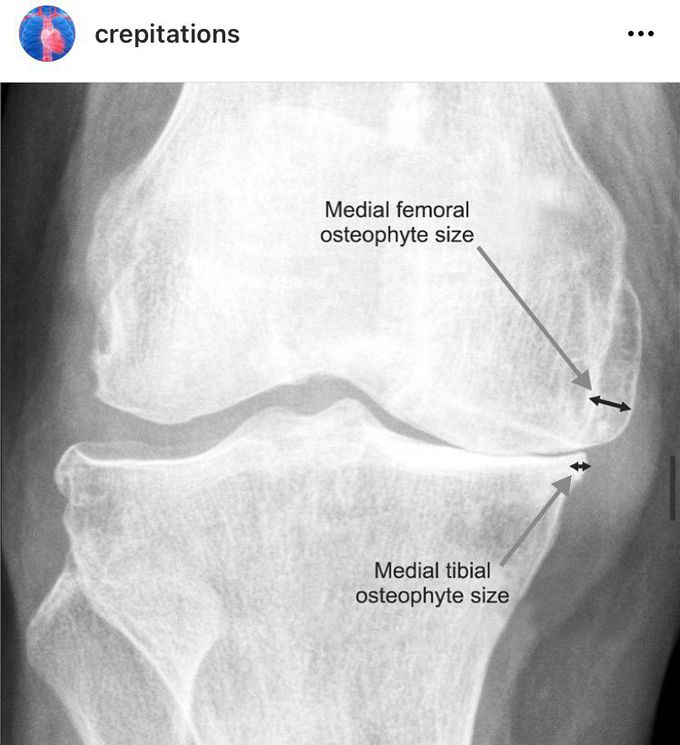 Osteophytes(bone spurs) X-Ray