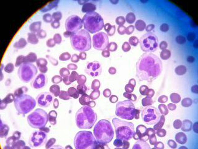 Leukaemia
