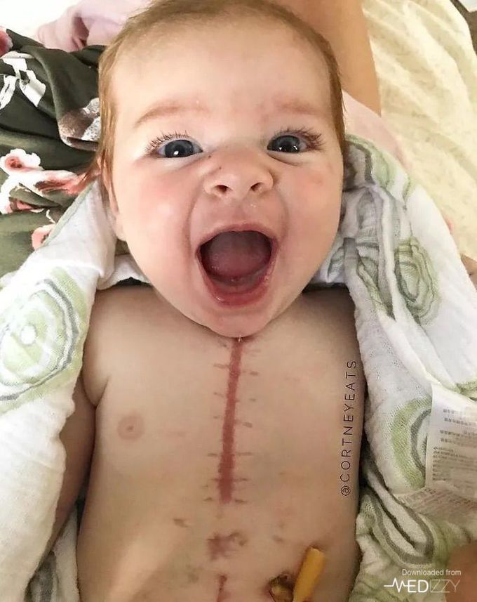 After heart surgery