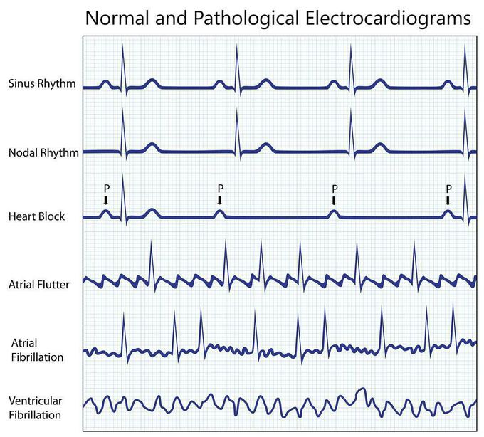 Type of ECG