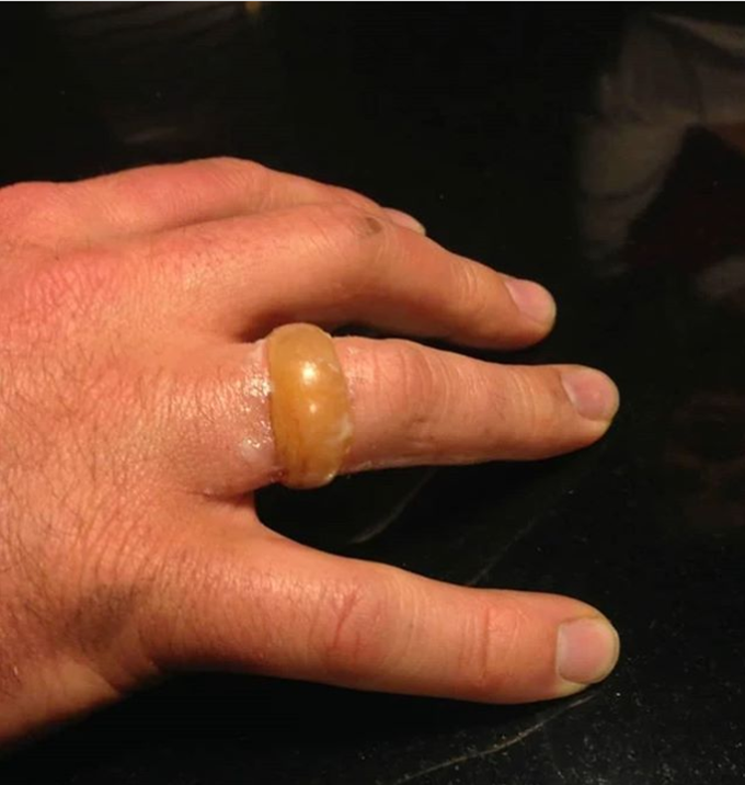 Is wearing a wedding band a health hazard?