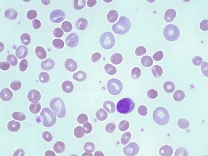 Hereditary Spherocytosis