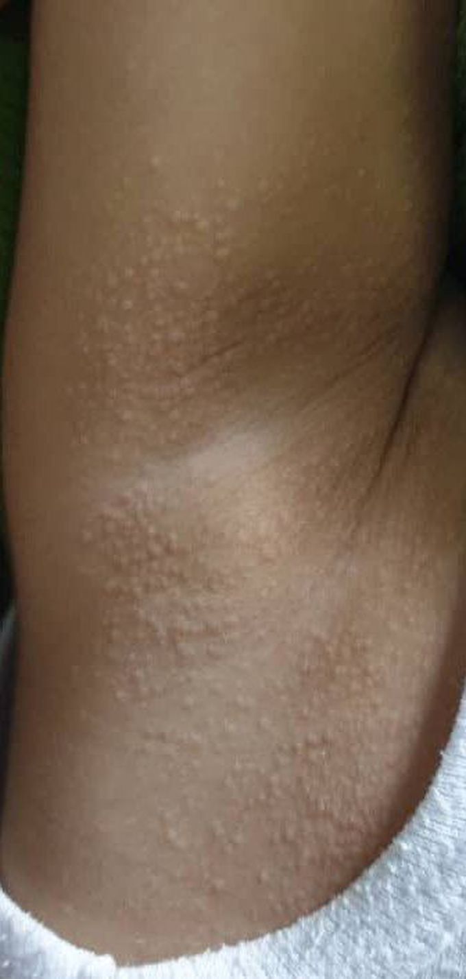 Skin-Colored papules