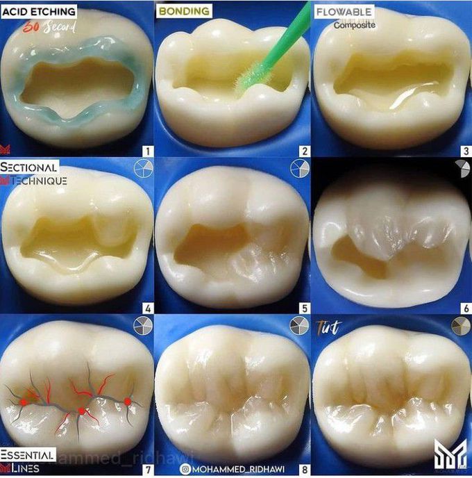 Step by step composite restoration