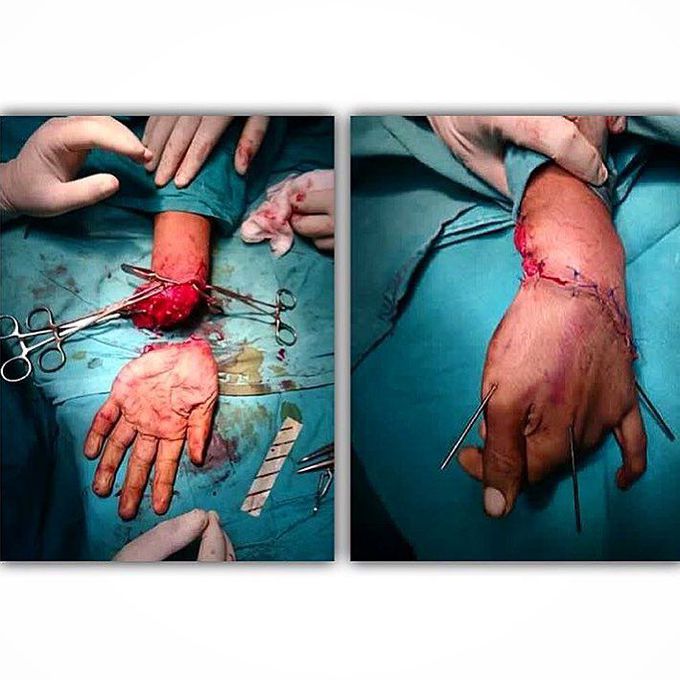 Hand reconstruction surgery