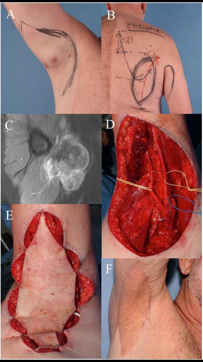 Case 1: (A) clinical visible mass in the right axilla, pre-OP drawing of the wide resection margins. (B)