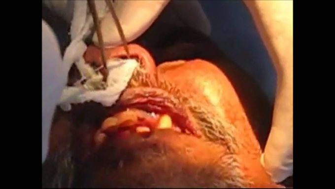 Anterior Nasal Packing