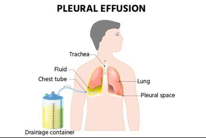 Pleural effusion