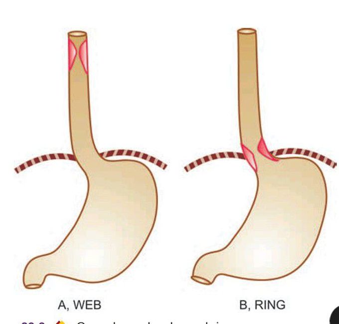 Oesophageal web and ring