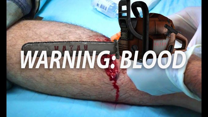 Dr. ER's Chainsaw Accident - Laceration Repaired!
