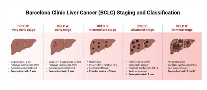 Liver Cancer Staging and Classification