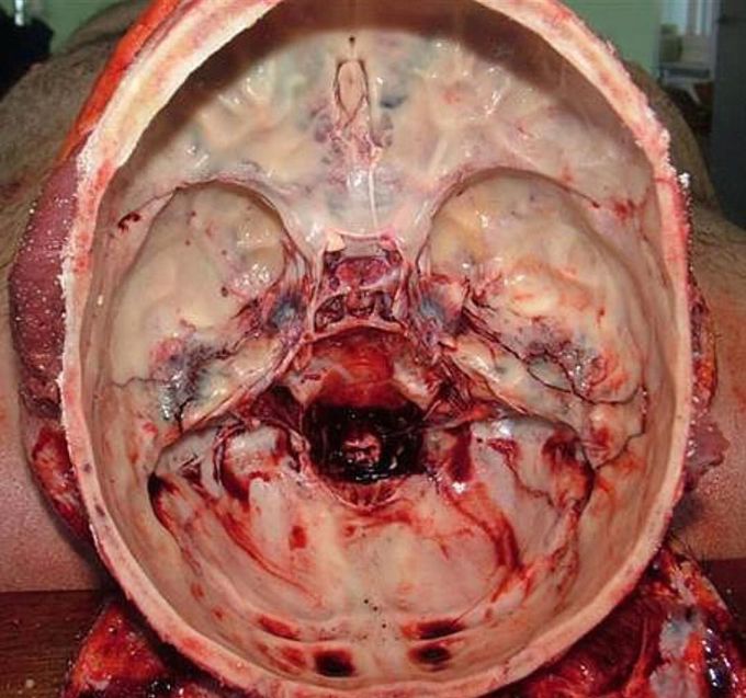 Fascinating view of an empty cranial cavity or vault after the extraction of the encephalon (brain) during an autopsy!