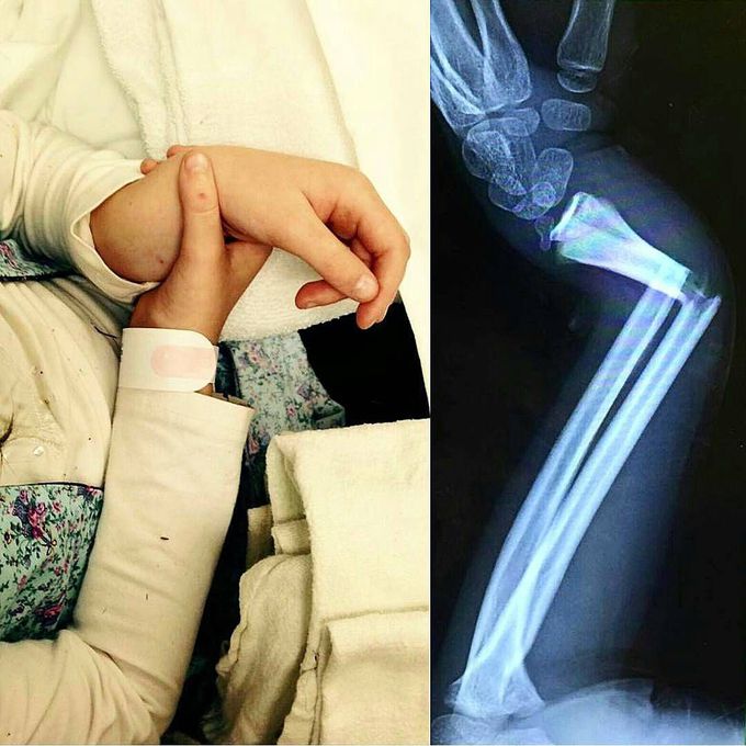 Radius and ulna fracture