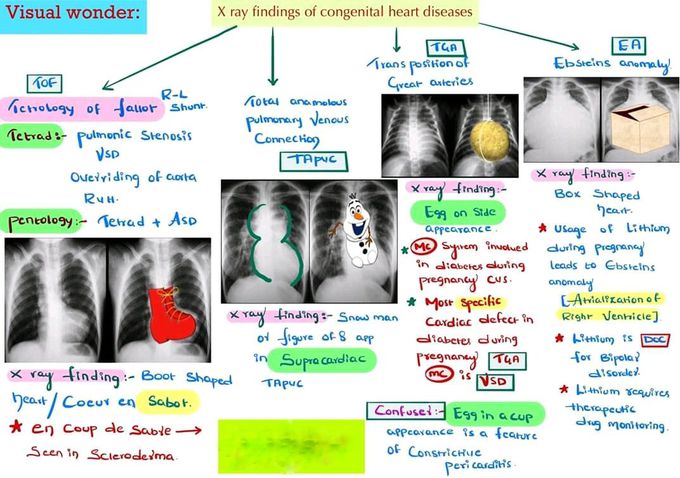 Congenital heart disease