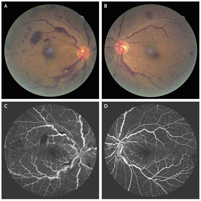 Hyperviscosity-Related Retinopathy in Waldenström’s Macroglobulinemia