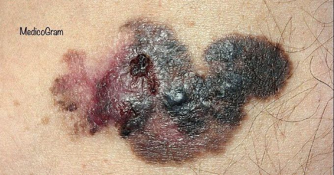 Melanoma