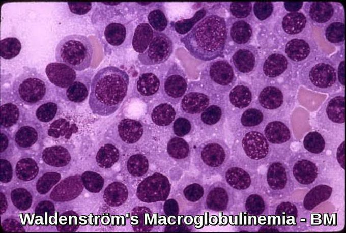 Waldenstorm Macroglobulinemia