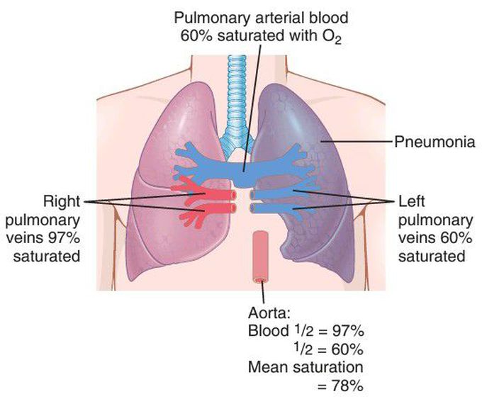 Pneumonia