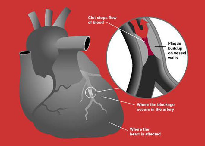 What is acute coronary syndrome