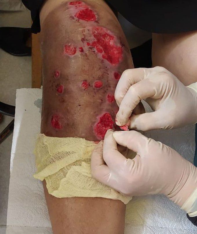 Cutaneous leishmaniasis is the most common form of leishmaniasis affecting humans. It is a skin infection caused by a single-celled parasite that is transmitted by the bite of a phlebotomine sand fly. There are about twenty species of Leishmania that may cause cutaneous leishmaniasis.