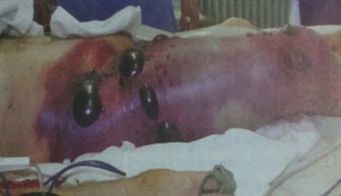 Gangrene