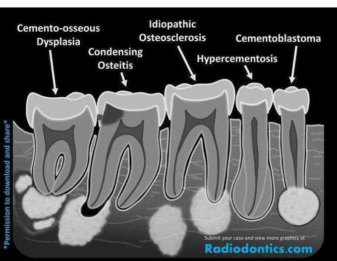 Apical Radiopacities