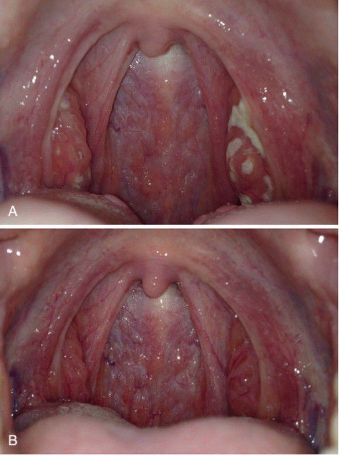 Tonsillitis