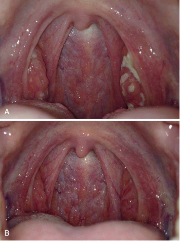 Tonsillitis