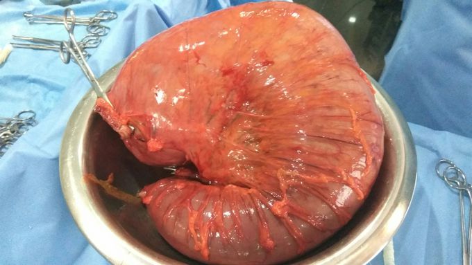 Sigmoid volvulus