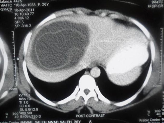 Hydatid Liver cyst