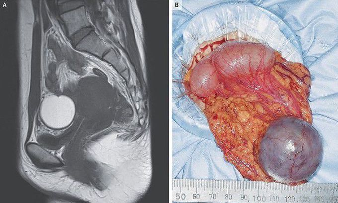 Omental Endometriosis