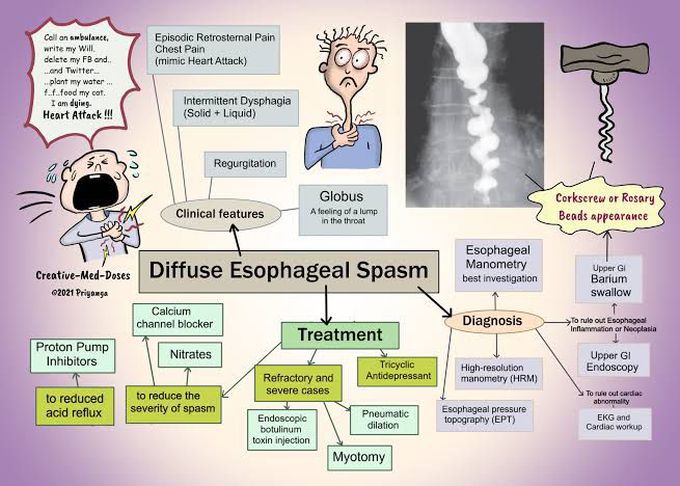 Diffuse Esophageal Spasm
