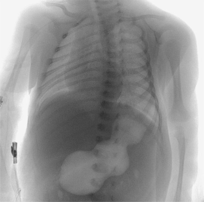 Caterpillar Sign in Infantile Hypertrophic Pyloric Stenosis