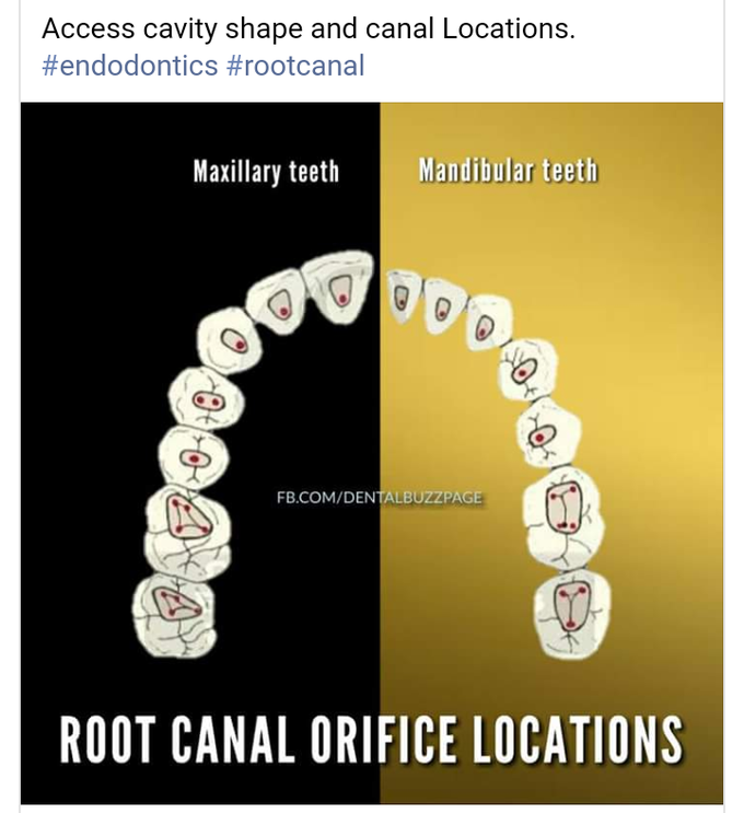 Root canal orofices...