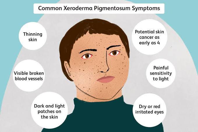 These are the symptoms of Xeroderma Pigmentosum syndrome