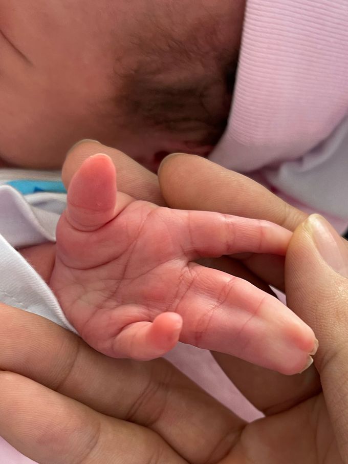 3 - 4 finger syndactyly in neonate