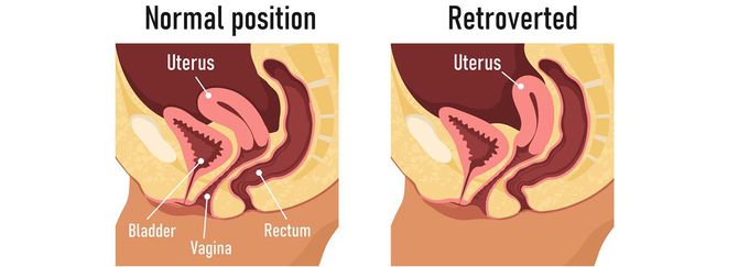 Does Retroverted Uterus Cause Problems?