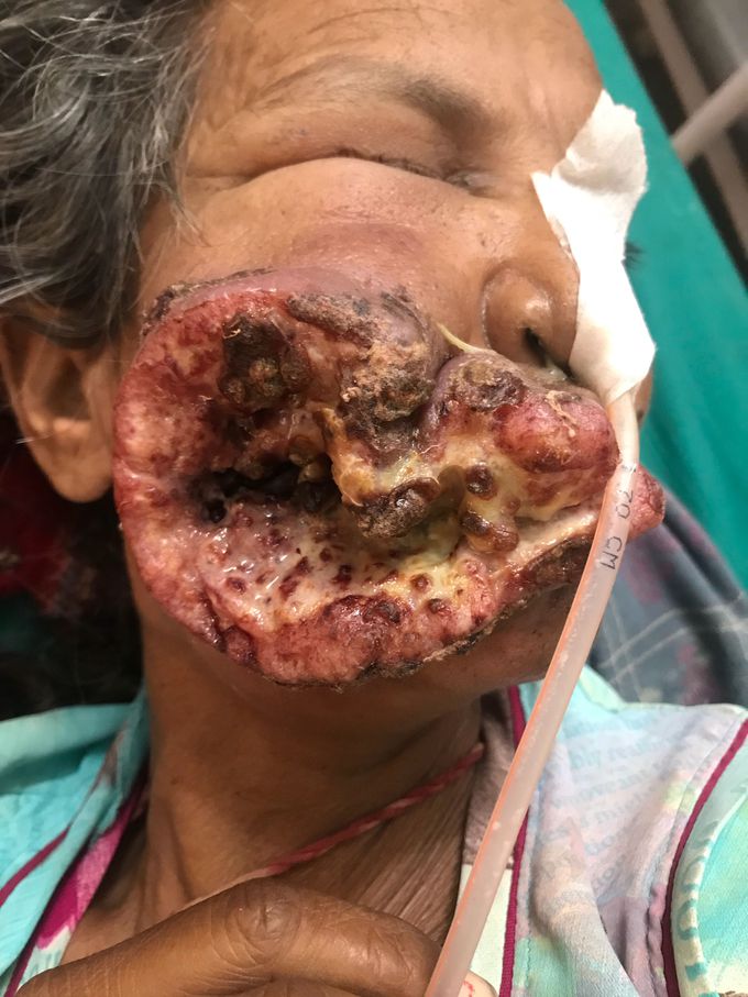 Buccal carcinoma