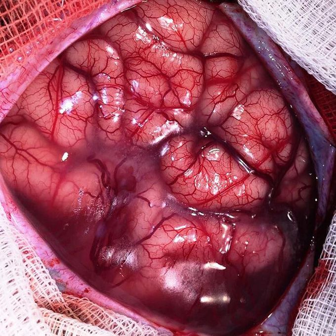 Tuberous sclerosis