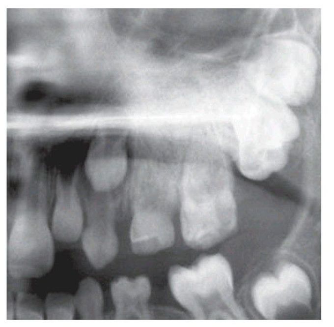 Segmental odontomaxillary dysplasia