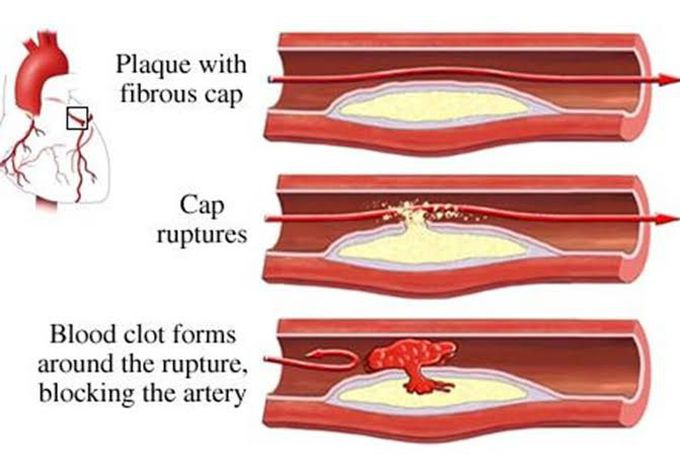 Symptoms of thrombosis