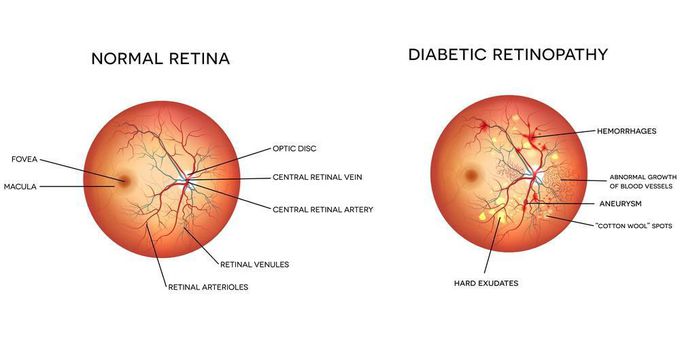 Diabetic retinopathy