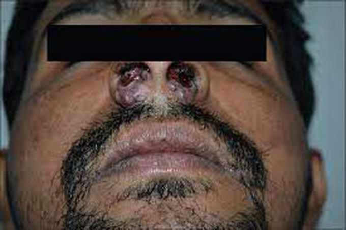 Treatment of rhinoscleroma