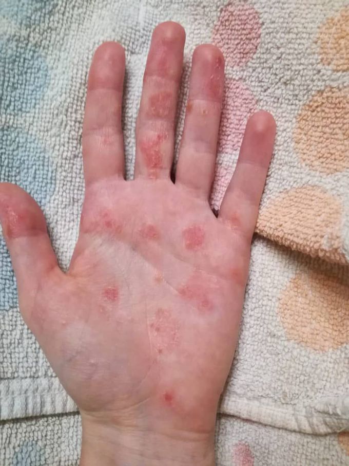 Diagnosis and treatment