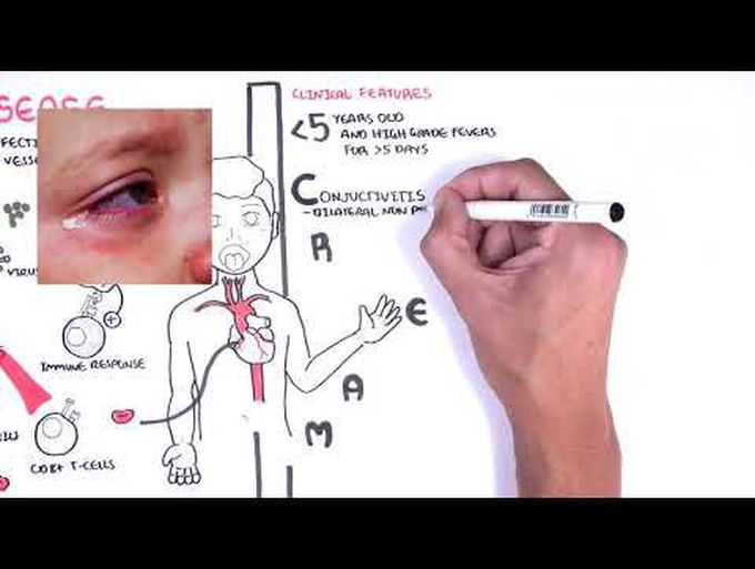 What is Kawasaki disease