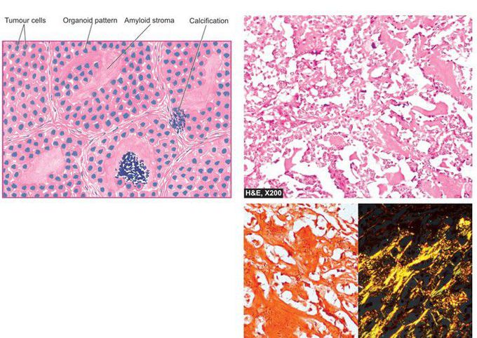 Medullary carcinoma thyroid